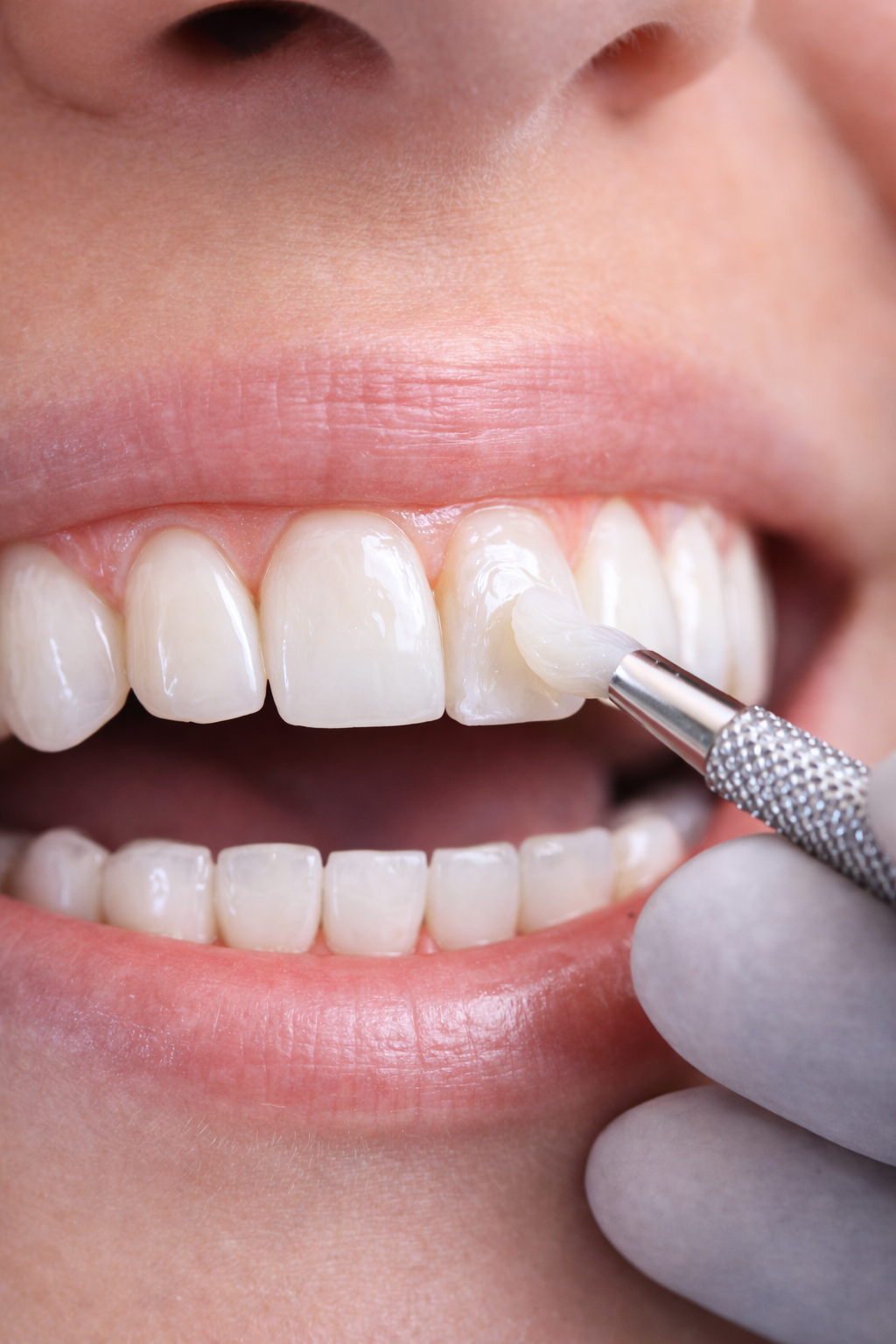 Bonding zębów Łódź – szybka poprawa estetyki uśmiechu